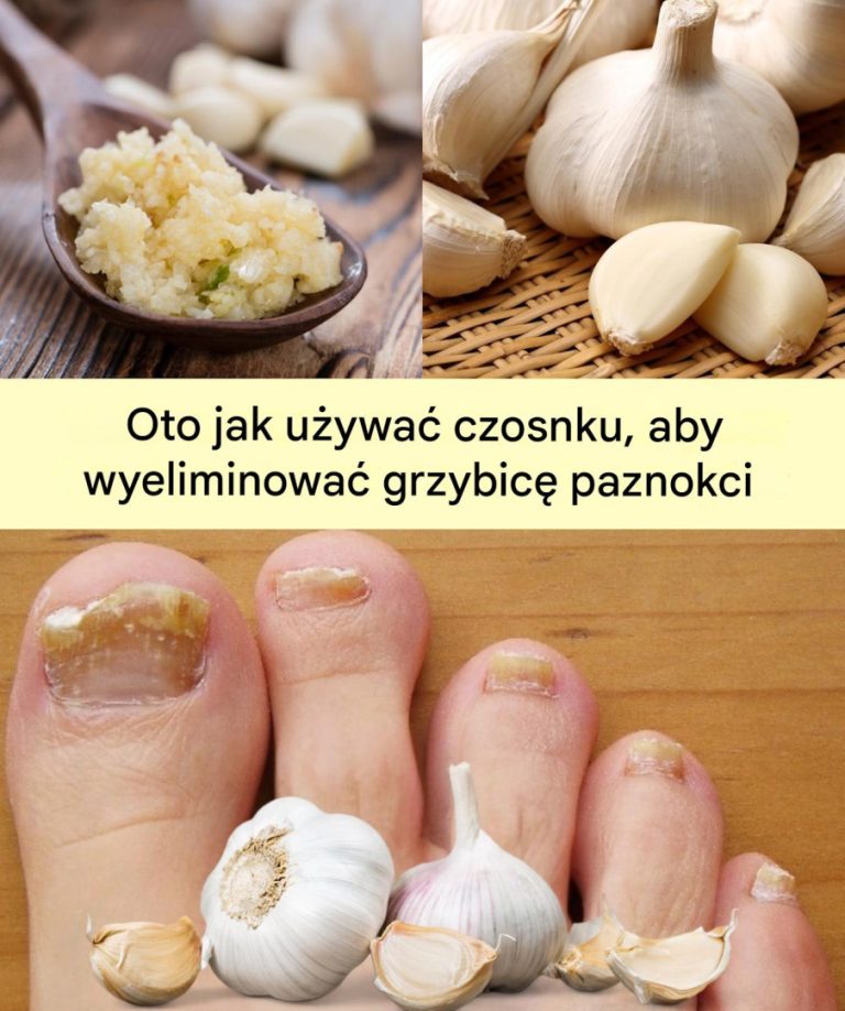 Czosnek: naturalny środek na infekcje grzybicze