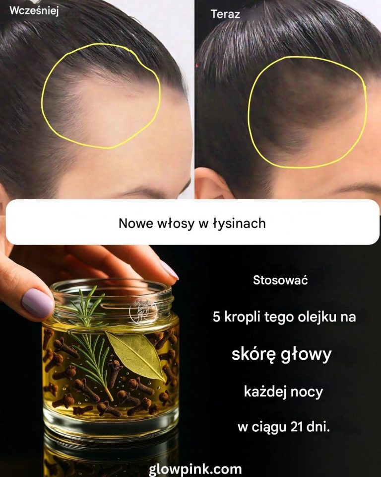 Olejek z goździków, rozmarynu i liści laurowych: jak wyhodować nowe włosy na łysych miejscach