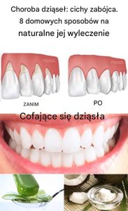 Choroba dziąseł: cichy zabójca. 8 zwykłych sposobów na naturalne jej wyleczenie