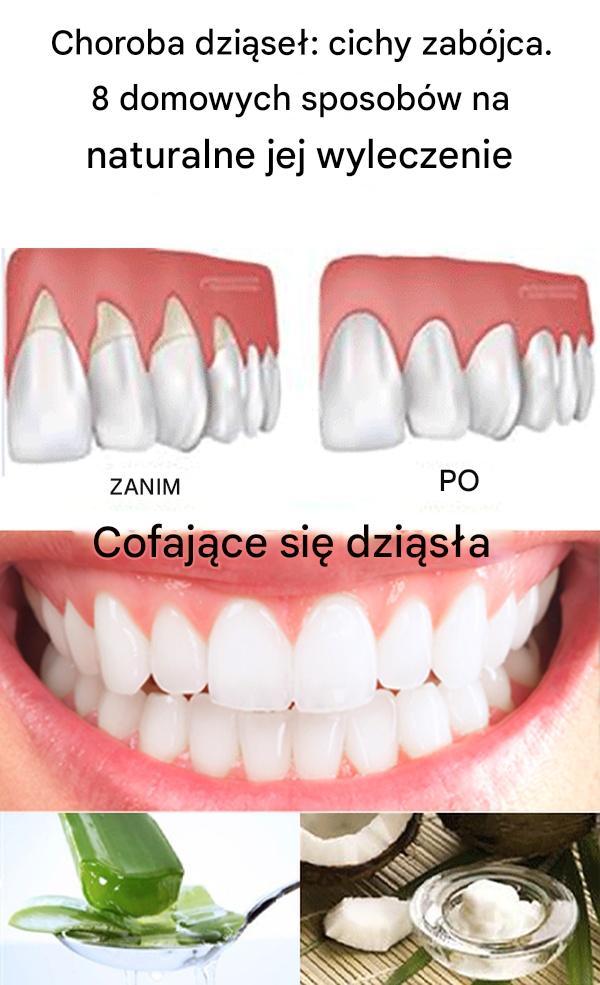 Choroba dziąseł: cichy zabójca. 8 domowych sposobów na naturalne jej wyleczenie
