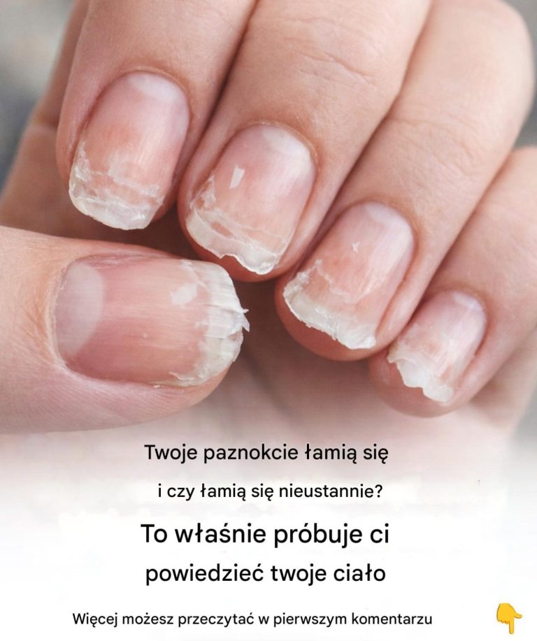 Łamliwe lub łamliwe paznokcie: co próbuje Ci powiedzieć Twoje ciało