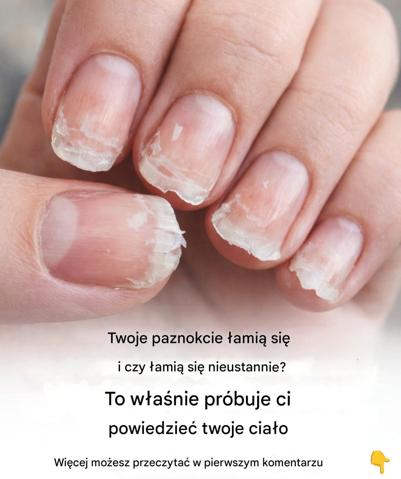 Łamliwe lub łamliwe paznokcie: co próbuje Ci powiedzieć Twoje ciało