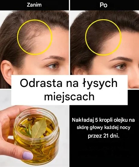 Olejek goździkowy, rozmaryn i liść laurowy: przywracają włos naturalny wzrost w miejscach łysienia