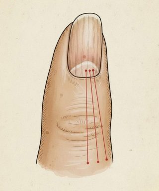 Se hai delle linee sulle unghie, significa che hai il cancro...Vedi altro