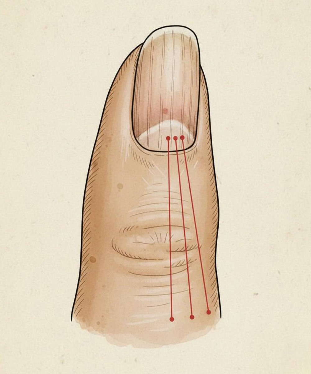 Se hai delle linee sulle unghie, significa che hai il cancro...Vedi altro