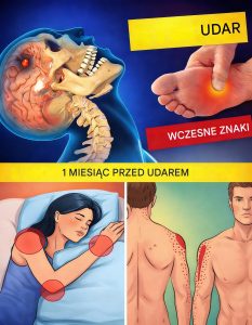 8 objawów ostrzegawczych udaru, które mogą pojawić się miesiąc wcześniej oraz 9 wskazówek, jak mu zapobiegać