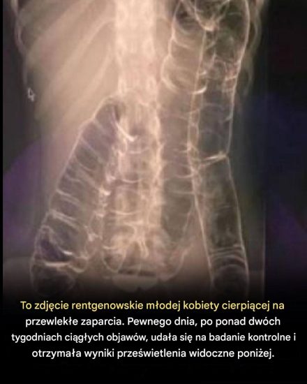 Ciężkie zaparcia i toksyczne megacolon: przyczyny i rozwiązania