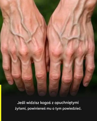 Jeśli Twoje żyły są widoczne, oznacza to, że… Zobacz więcej