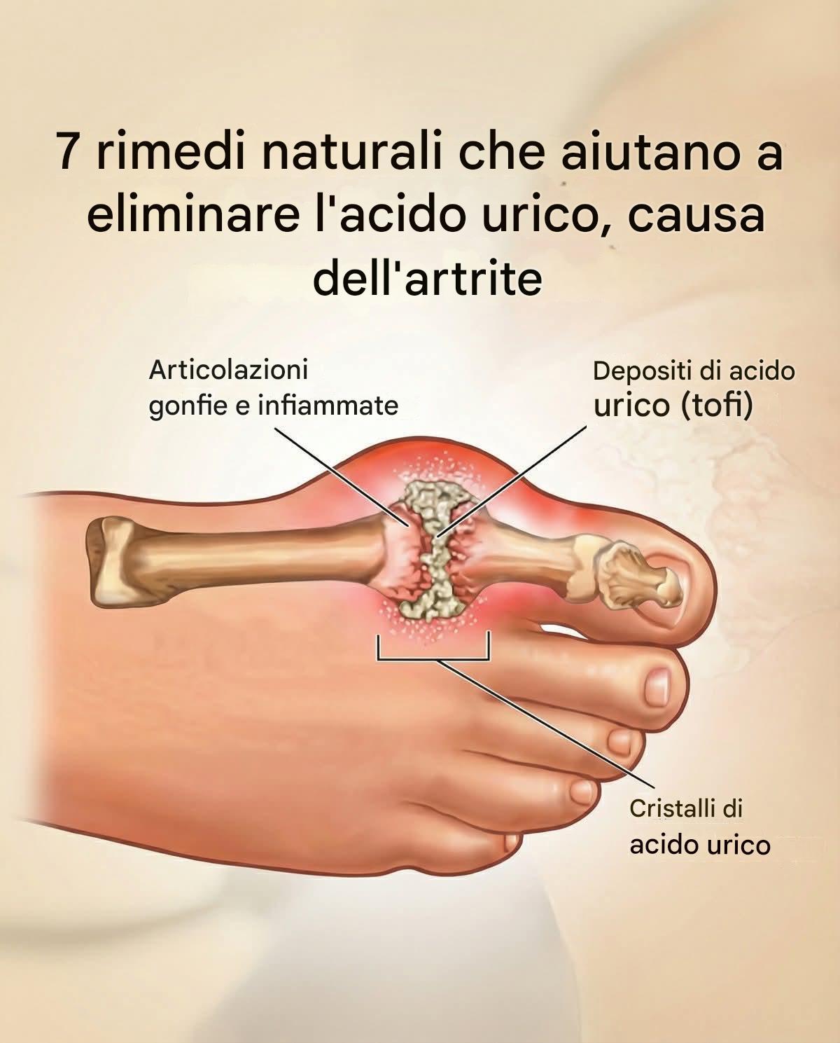 7 rimedi naturali che aiutano a eliminare l'acido urico, causa dell'artrite (link nei commenti)