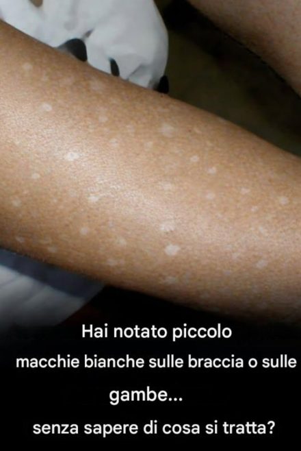 Piccole macchie bianche su braccia e gambe: ecco cosa devi sapere