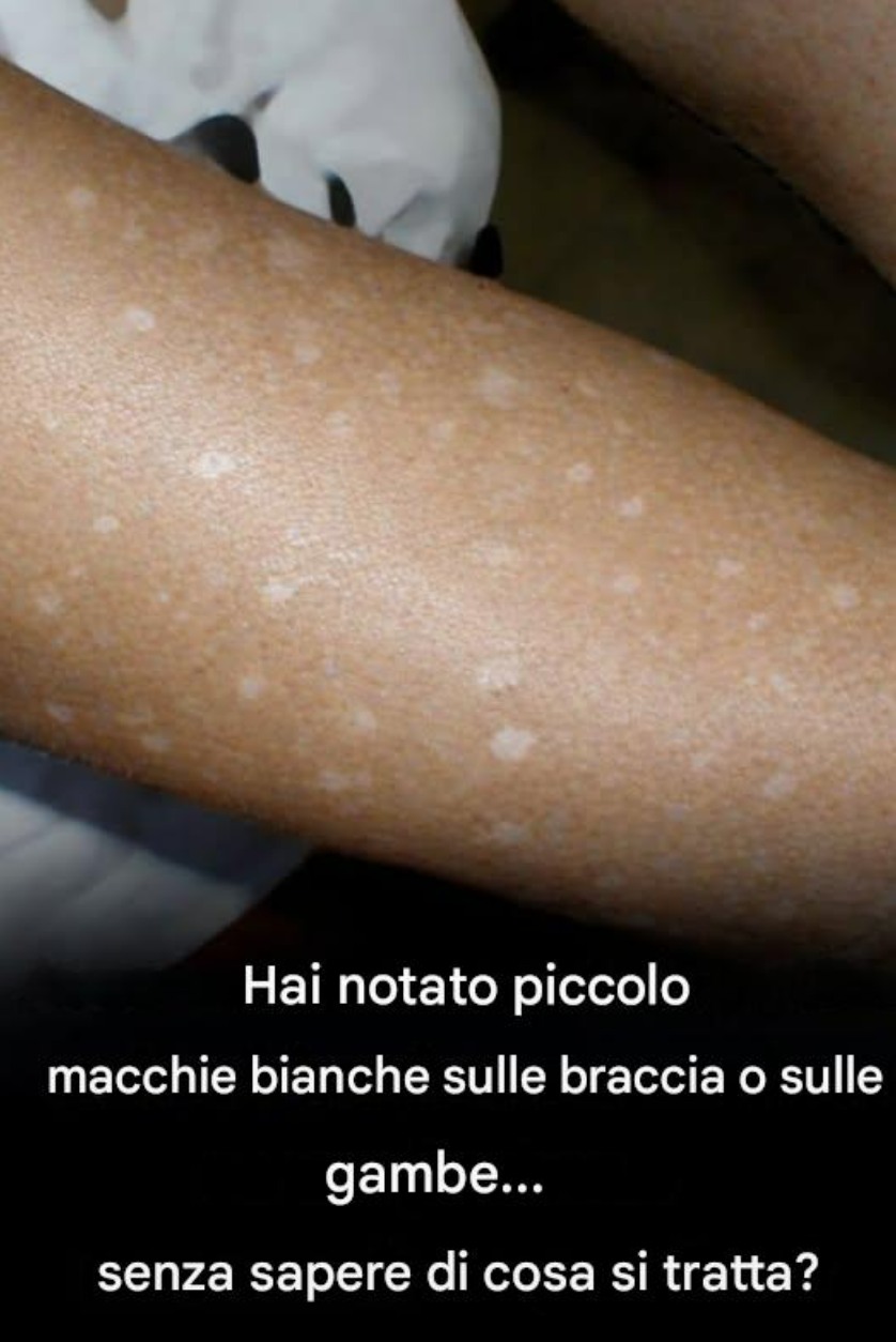 Piccole macchie bianche su braccia e gambe: ecco cosa devi sapere